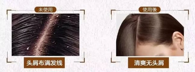 告別脫發(fā)、頭皮屑與頭發(fā)稀少的煩惱，重塑烏黑濃密的秀發(fā)